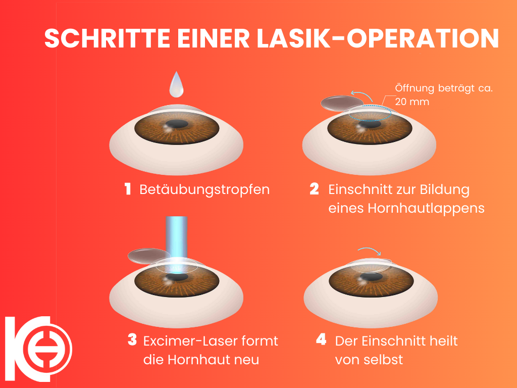 lasik goz lazer de