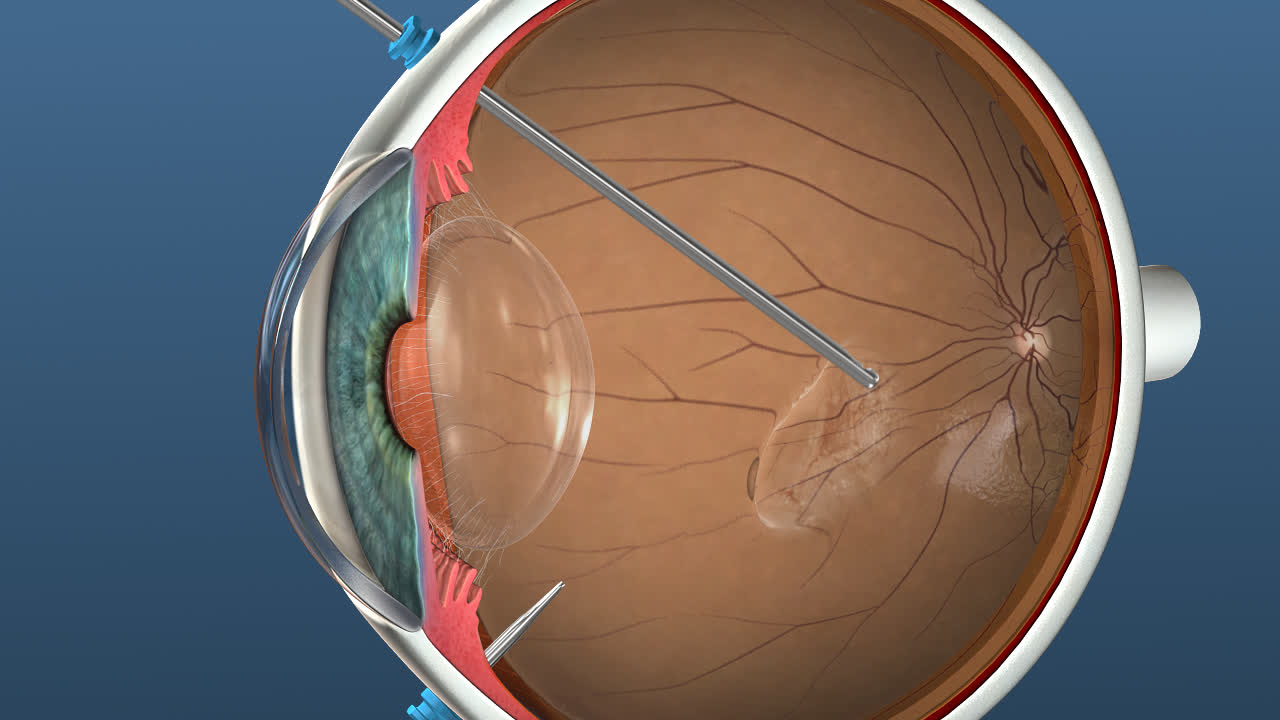 Retina Dekolmani2