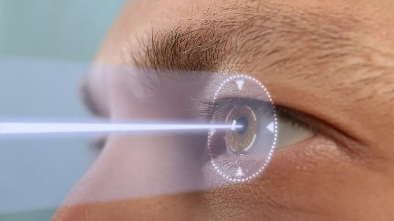 iDesign laser eye surgery in Turkey