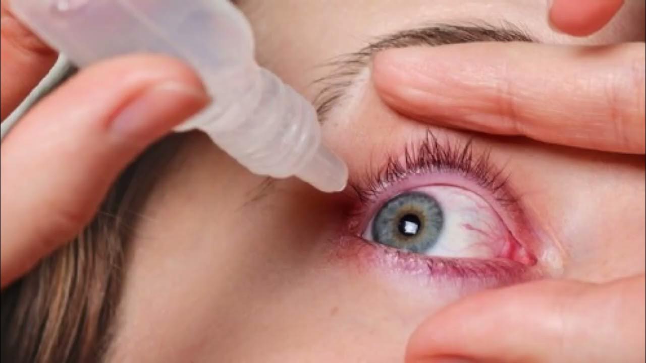 Aşırı Göz Kuruluğu Tedavisi 1 Aşırı Göz Kuruluğu