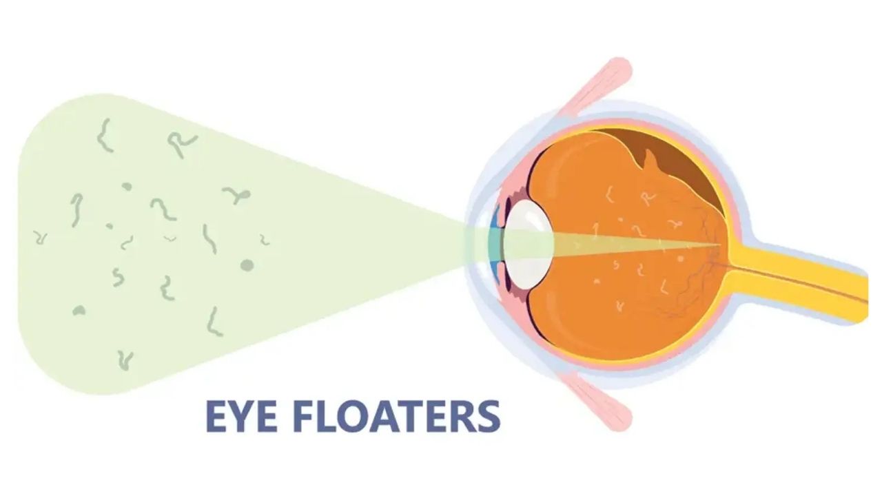 Treatment for Floaters in Eyes