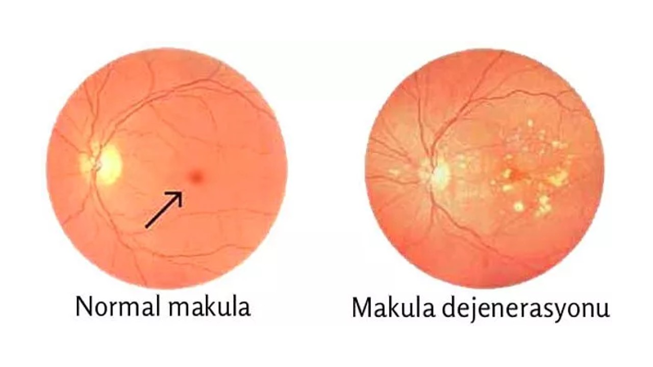 Maküler Dejenerasyon