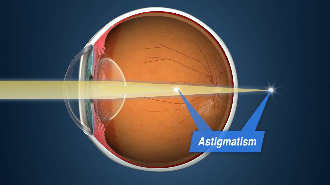 Hipermetrop astigmat nedir?