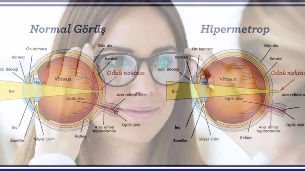 Hipermetrop Nedir 2 hipermetrop