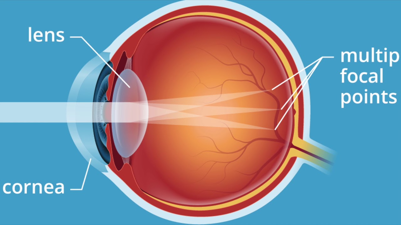 Astigmat Nasıl Görür? 2 Astigmat nasıl görür