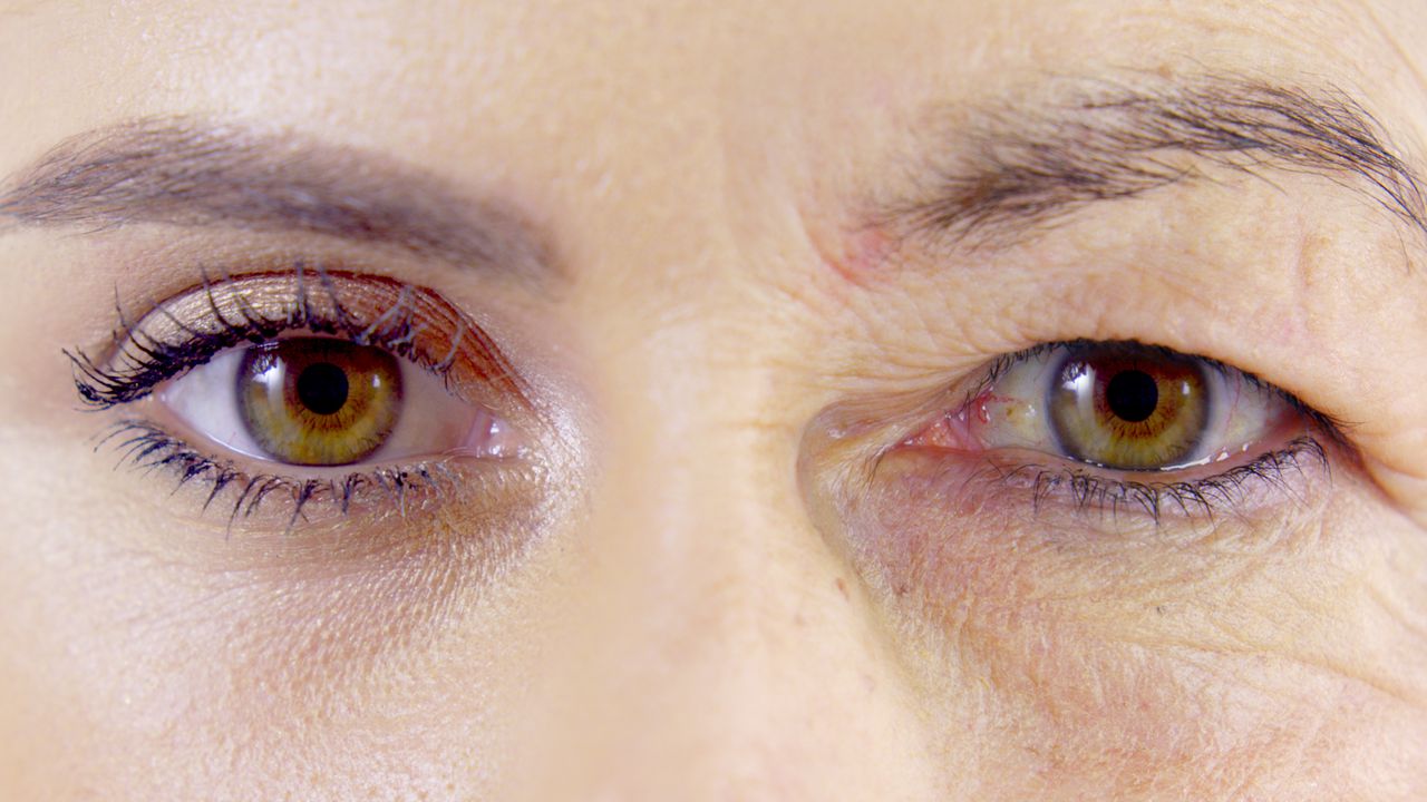 Göz Kapağı Düşüklüğü Ameliyatı 2 goz kapagi dusuklugu 2