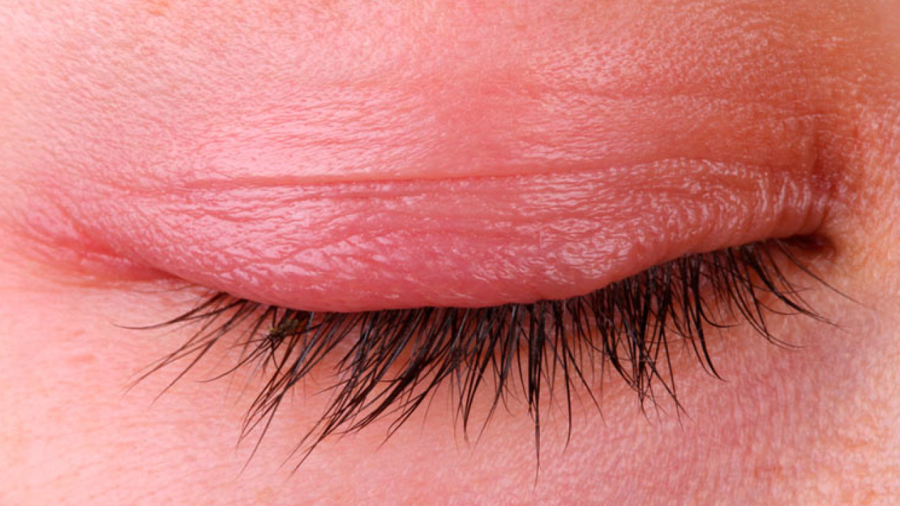 Şalazyon (Göz Kapağı Kisti) Nedir? 1 salazyon2