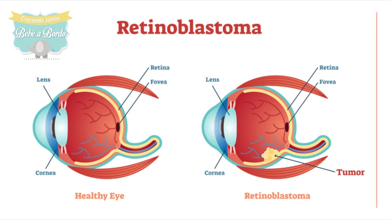 Retina Yırtığı Belirtileri 2 Retina Yirtigi2