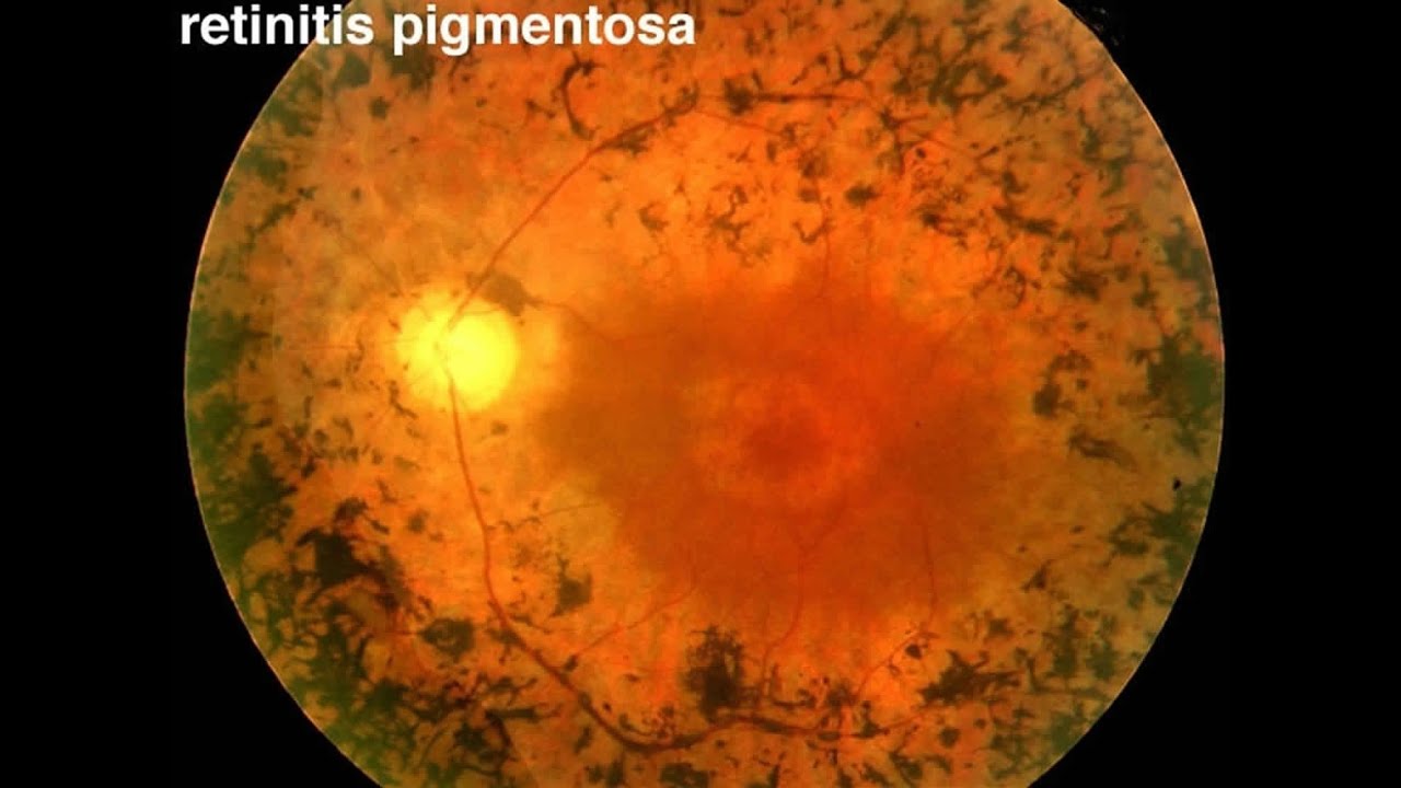 Retinitis Pigmentosa Nedir? 1 Retinitis Pigmentosa2