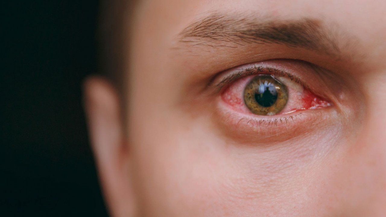 Göz Enfeksiyonu Bulaşıcı Mı?