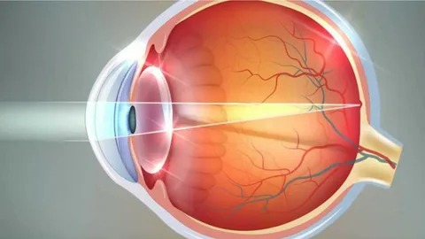 H52.2 Astigmatizma Nedir